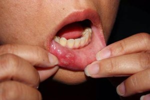 herpes-on-mouth-4